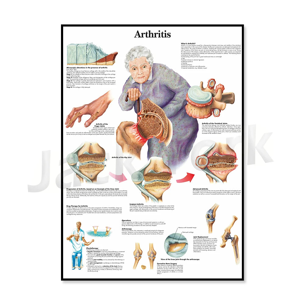 Cette affiche détaille les différents types d'arthrite et les traitements possibles, à l'aide d'illustrations montrant les articulations affectées et les interventions chirurgicales.